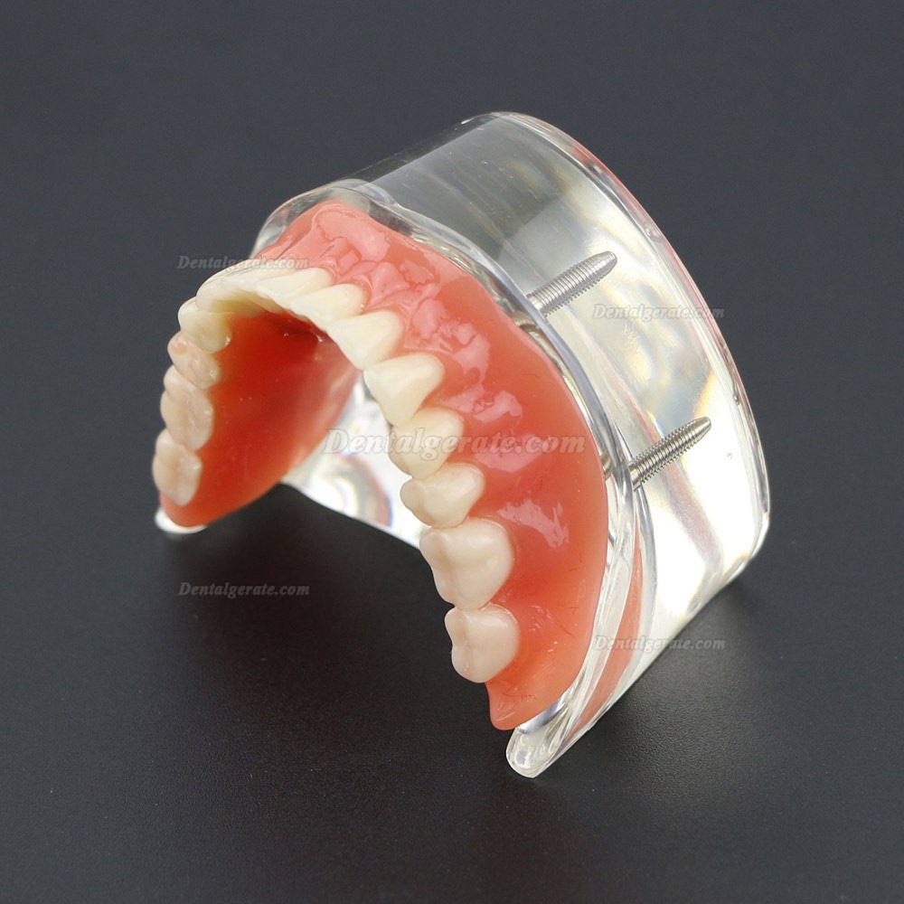 Dental Lower Z&auml;hne Demo-Studienmodell 6002 02 Overdenture Unten 4 Implantate